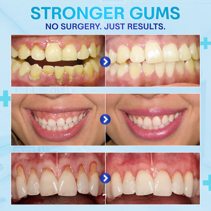 🔥🔥🔥Last Day 75% OFF--🦷 Negusy™ Gum Therapy Agent