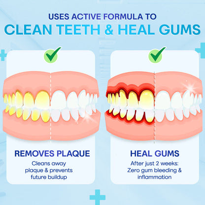 🔥🔥🔥Last Day 75% OFF--🦷 Negusy™ Gum Therapy Agent