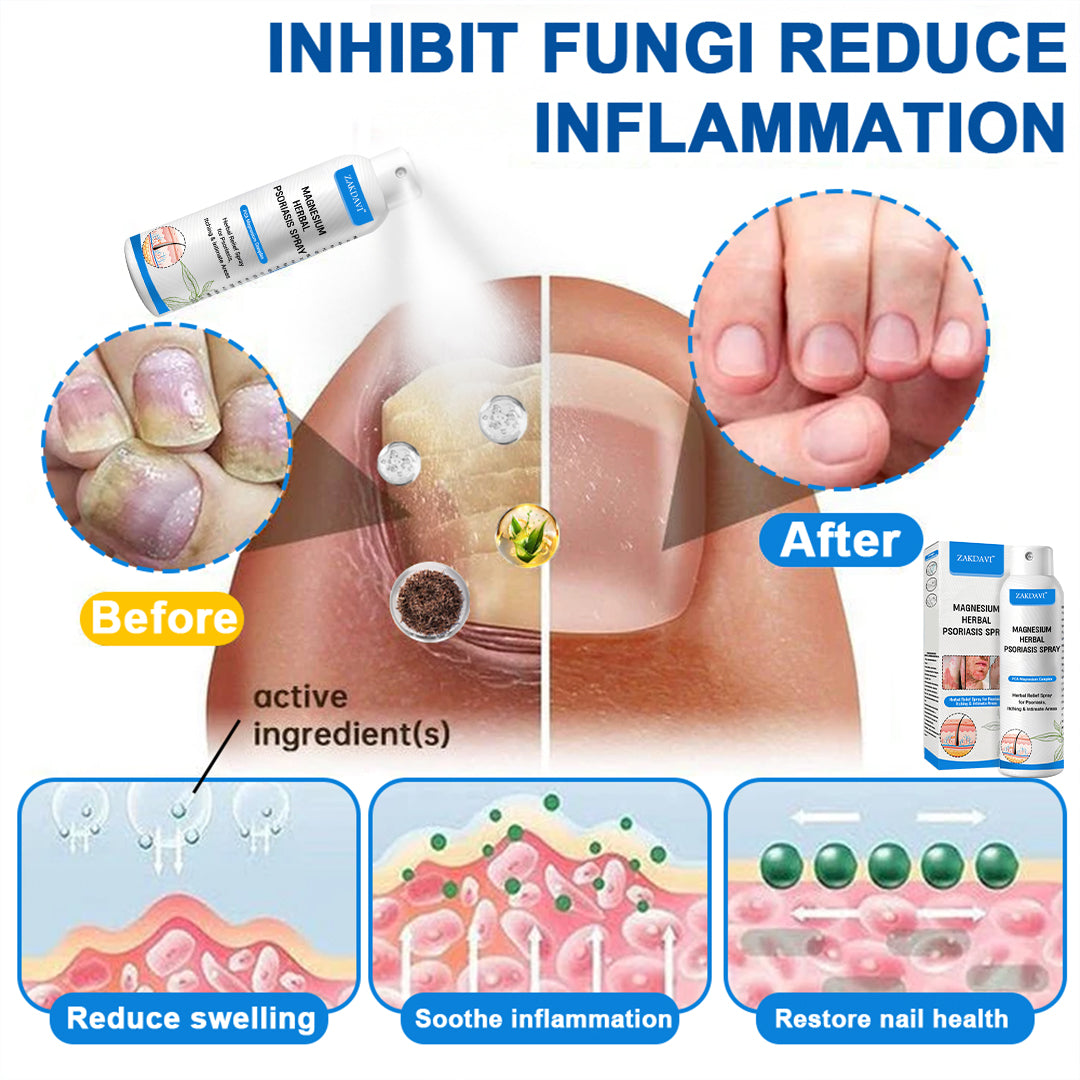 ✅ Zakdavi™ Magnesium Herbal Psoriasis Spray – FDA Certified Relief for Psoriasis, Eczema & Skin Tags