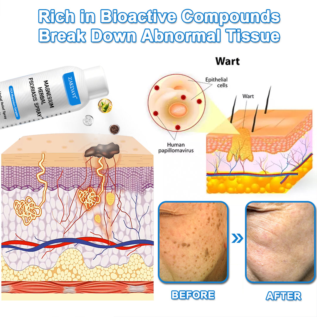 ✅ Zakdavi™ Magnesium Herbal Psoriasis Spray – FDA Certified Relief for Psoriasis, Eczema & Skin Tags