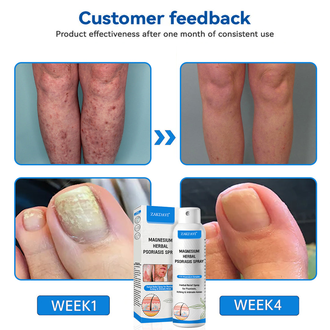 ✅ Zakdavi™ Magnesium Herbal Psoriasis Spray – FDA Certified Relief for Psoriasis, Eczema & Skin Tags