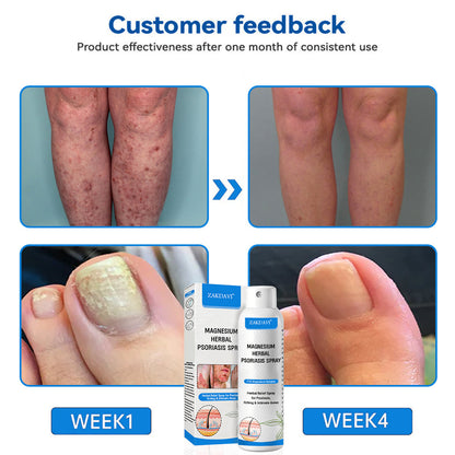 ✅ Zakdavi™ Magnesium Herbal Psoriasis Spray – FDA Certified Relief for Psoriasis, Eczema & Skin Tags