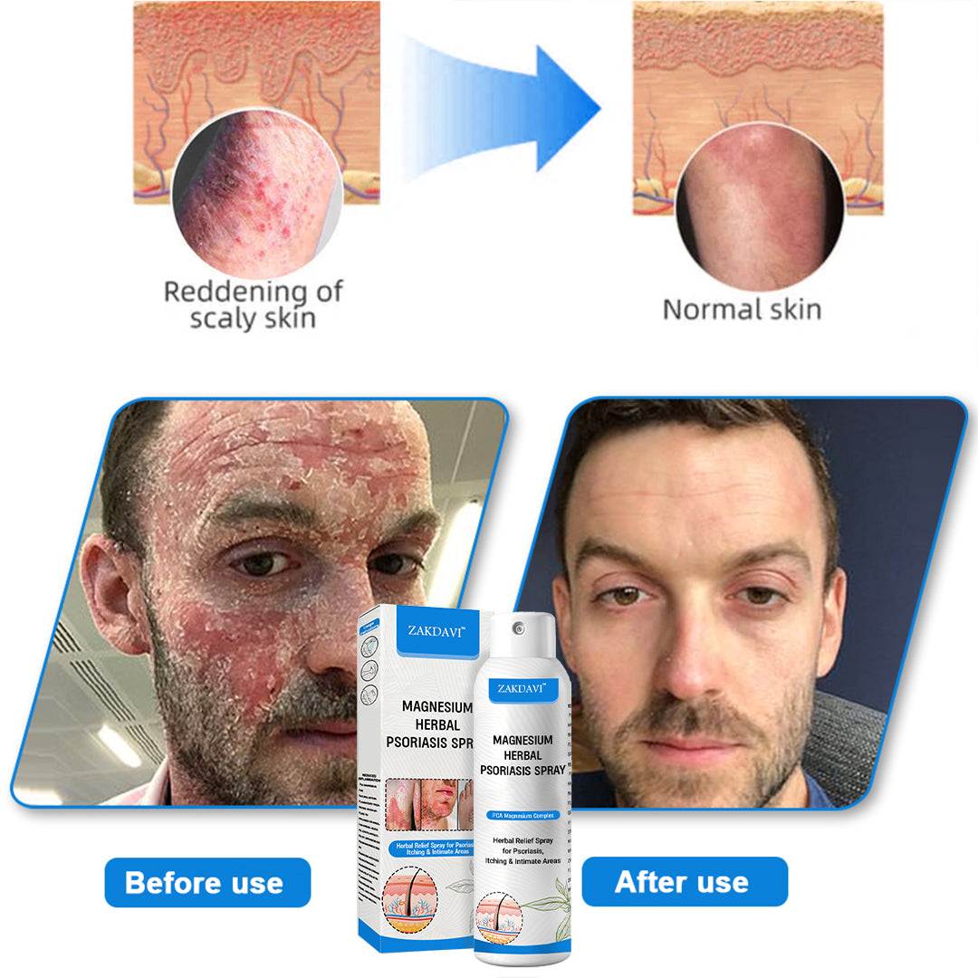 ✅ Zakdavi™ Magnesium Herbal Psoriasis Spray – FDA Certified Relief for Psoriasis, Eczema & Skin Tags